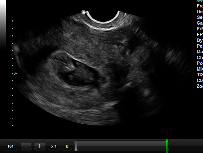 ultrasound